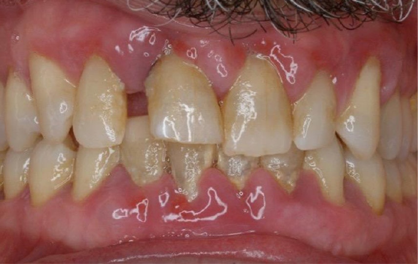 periodontitis1