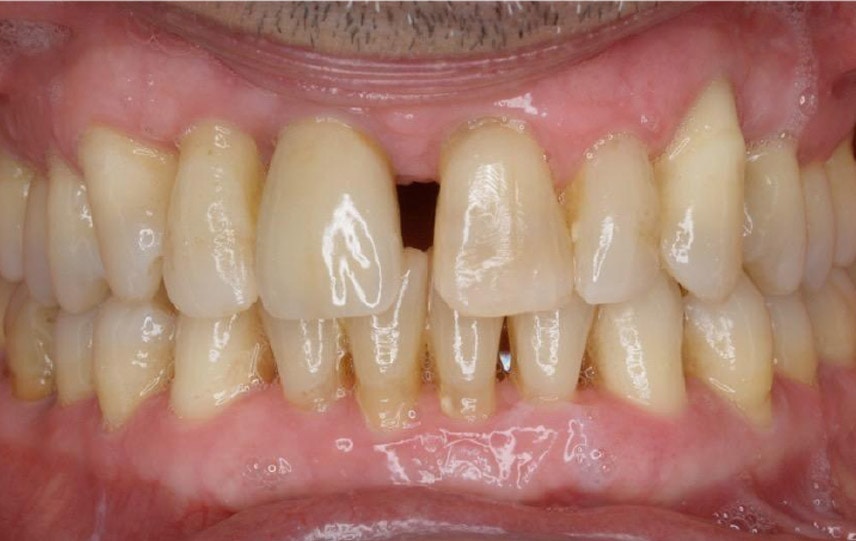 periodontitis11