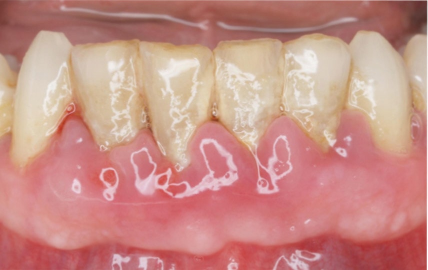 periodontitis2