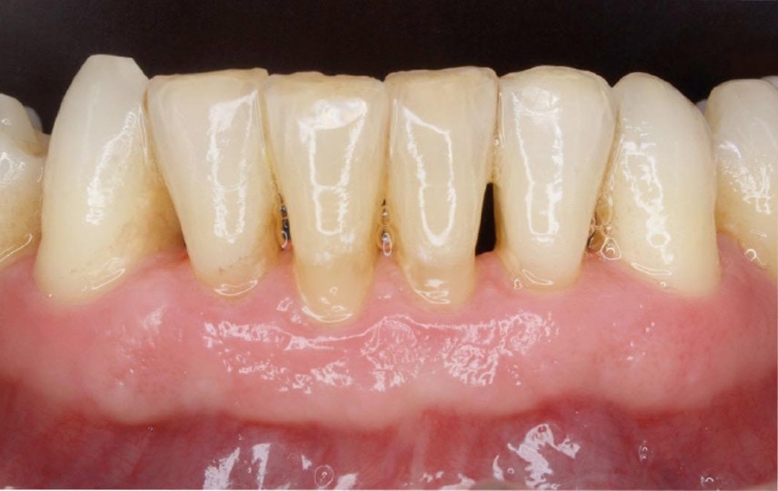 periodontitis22